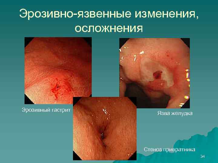 Эрозивно-язвенные изменения, осложнения Эрозивный гастрит Язва желудка Стеноз привратника 34 