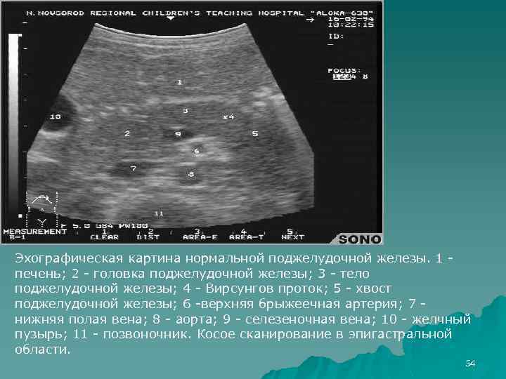 Эхографическая картина нормальной поджелудочной железы. 1 печень; 2 - головка поджелудочной железы; 3 -