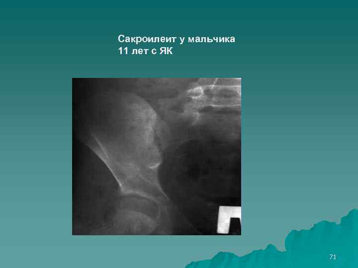 Сакроилеит у мальчика 11 лет с ЯК 71 
