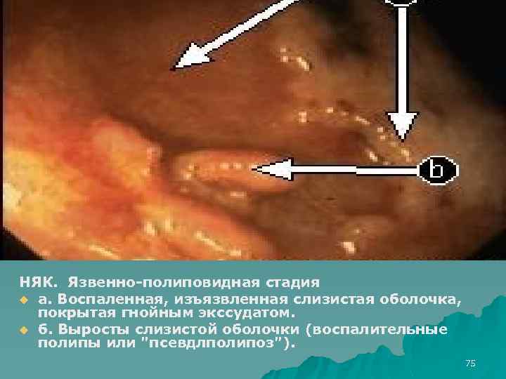 НЯК. Язвенно-полиповидная стадия u а. Воспаленная, изъязвленная слизистая оболочка, покрытая гнойным экссудатом. u б.