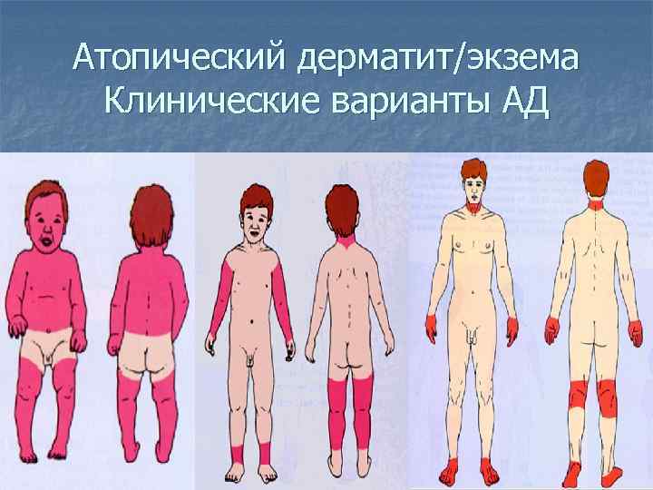 Атопический дерматит/экзема Клинические варианты АД 