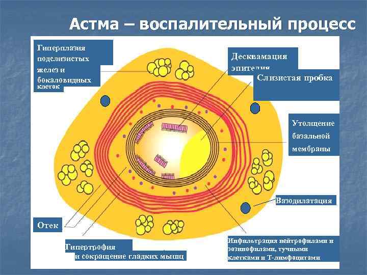 Астма – воспалительный процесс Гиперплазия подслизистых желез и бокаловидных Десквамация эпителия Слизистая пробка клеток