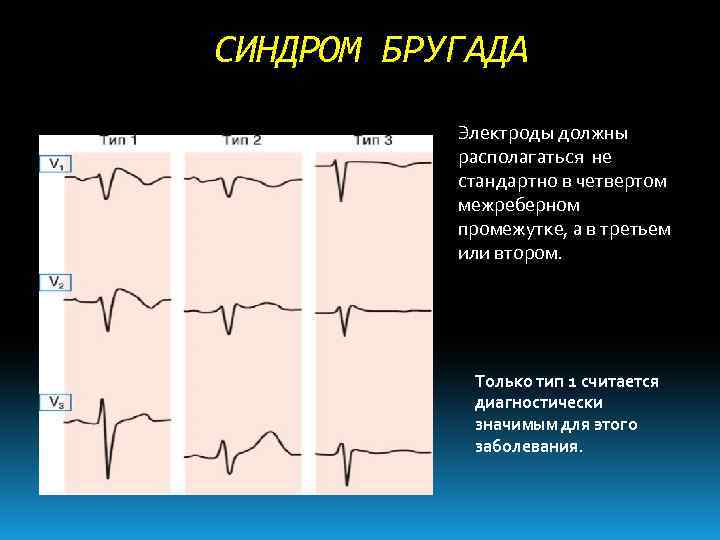 Синдром бругада презентация