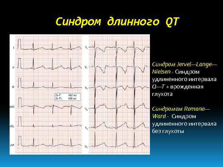 Удлинение интервала qt