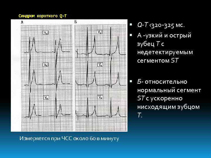 Феномен укороченного pq. ЭКГ при синдроме CLC. CLC синдром ЭКГ. Узкий и высокий зубец т на ЭКГ. Высокий остроконечный зубец т на ЭКГ.