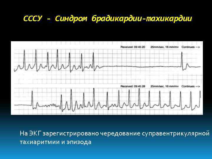 Холтер брадикардия. Синдром брадикардии-тахикардии на ЭКГ. Синдром бради-тахикардии на ЭКГ. Синусовая бради тахикардия. Синусовая бради и тахикардия на ЭКГ.