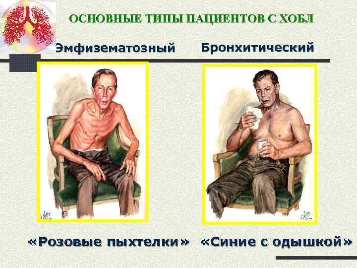 ОСНОВНЫЕ ТИПЫ ПАЦИЕНТОВ С ХОБЛ Эмфизематозный Бронхитический «Розовые пыхтелки» «Синие с одышкой» 