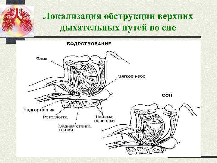 Локализация обструкции верхних дыхательных путей во сне 