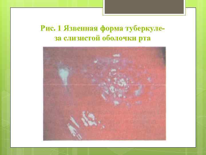 Рис. 1 Язвенная форма туберкулеза слизистой оболочки рта 