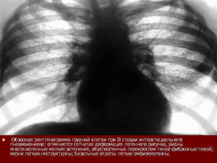 n Обзорная рентгенограмма грудной клетки при II стадии интерстициального пневмокониоза: отмечается сетчатая деформация легочного
