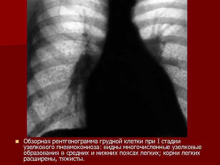 n Обзорная рентгенограмма грудной клетки при I стадии узелкового пневмокониоза: видны многочисленные узелковые образования