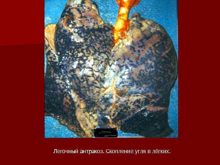 Легочный антракоз. Скопление угля в лёгких. 