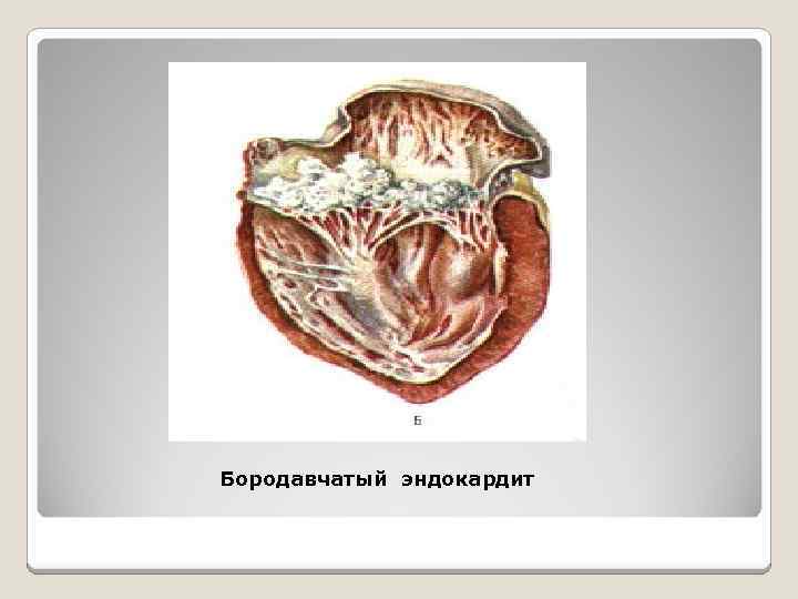 Бородавчатый эндокардит 