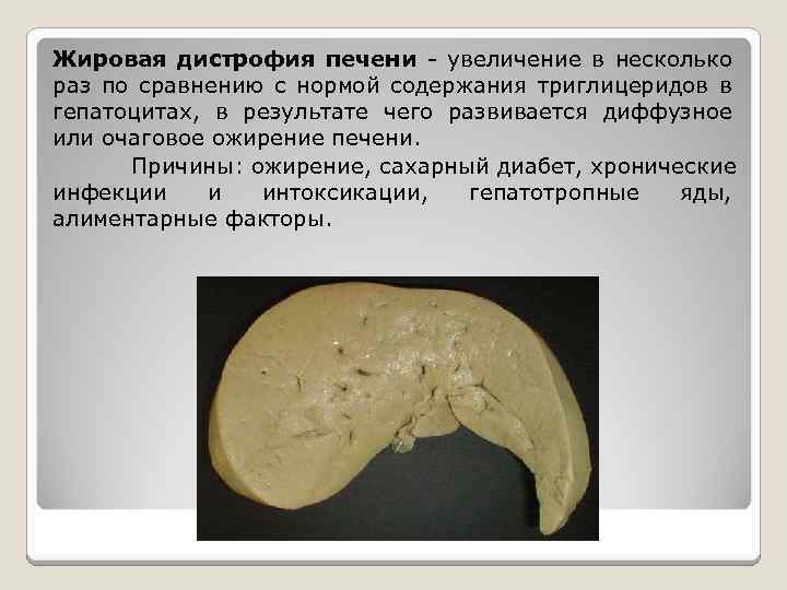 Жировая дистрофия печени - увеличение в несколько раз по сравнению с нормой содержания триглицеридов