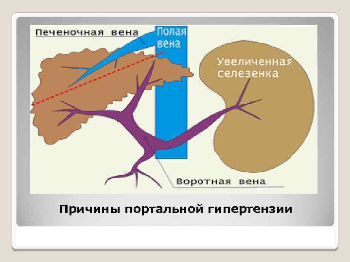 Причины портальной гипертензии 