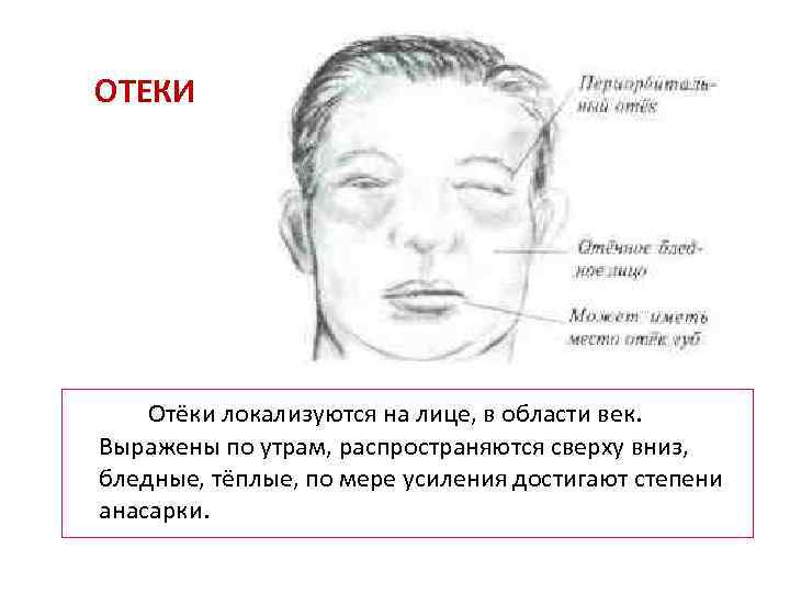 ОТЕКИ Отёки локализуются на лице, в области век. Выражены по утрам, распространяются сверху вниз,