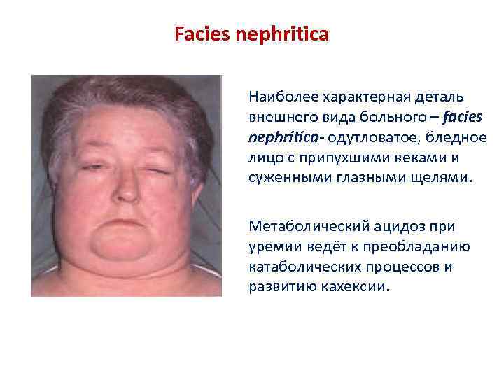 Facies nephritica Наиболее характерная деталь внешнего вида больного – facies nephritica- одутловатое, бледное лицо