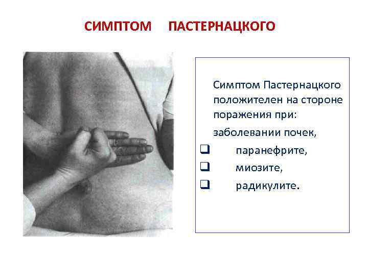 СИМПТОМ ПАСТЕРНАЦКОГО Симптом Пастернацкого положителен на стороне поражения при: заболевании почек, паранефрите, миозите, радикулите.