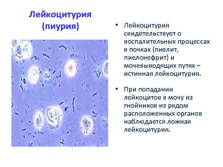 Лейкоцитурия (пиурия) • Лейкоцитурия свидетельствует о воспалительных процессах в почках (пиелит, пиелонефрит) и мочевыводящих