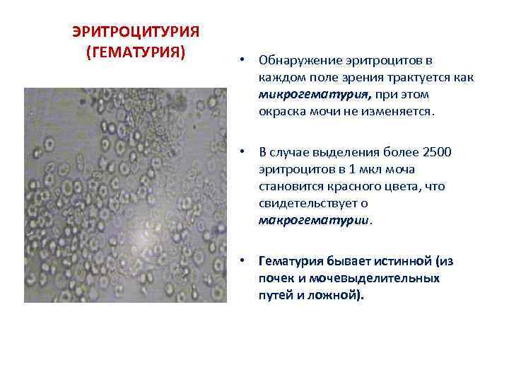 ЭРИТРОЦИТУРИЯ (ГЕМАТУРИЯ) • Обнаружение эритроцитов в каждом поле зрения трактуется как микрогематурия, при этом