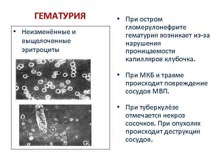 ГЕМАТУРИЯ • Неизменённые и выщелоченные эритроциты • При остром гломерулонефрите гематурия возникает из-за нарушения