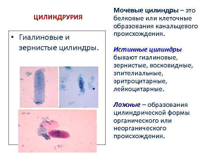 ЦИЛИНДРУРИЯ • Гиалиновые и зернистые цилиндры. Мочевые цилиндры – это белковые или клеточные образования