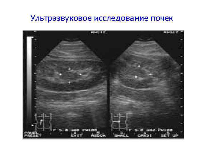 Ультразвуковое исследование почек 