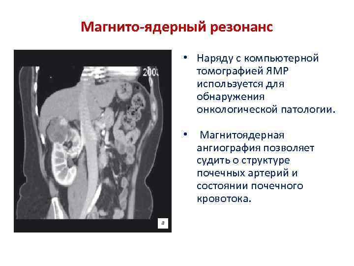 Магнито-ядерный резонанс • Наряду с компьютерной томографией ЯМР используется для обнаружения онкологической патологии. •