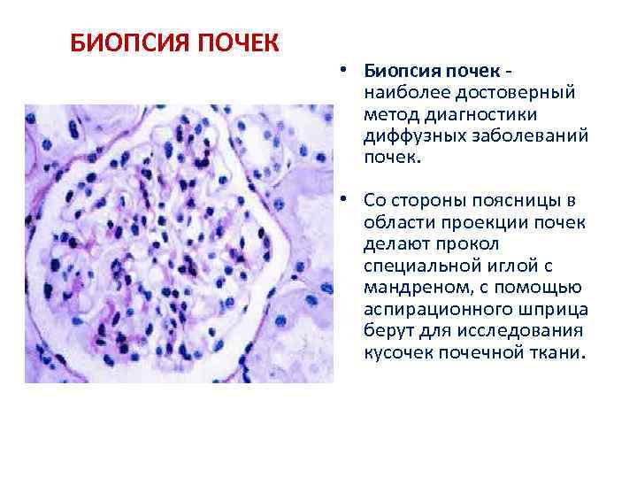 БИОПСИЯ ПОЧЕК • Биопсия почек - наиболее достоверный метод диагностики диффузных заболеваний почек. •