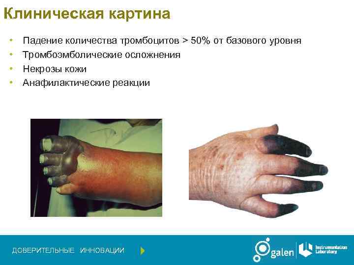 Клиническая картина • • Падение количества тромбоцитов > 50% от базового уровня Тромбоэмболические осложнения