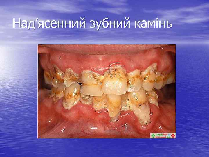 Над’ясенний зубний камінь 