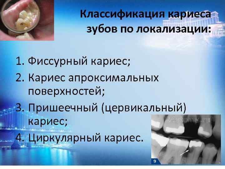 Классификация кариеса зубов по локализации: 1. Фиссурный кариес; 2. Кариес апроксимальных поверхностей; 3. Пришеечный