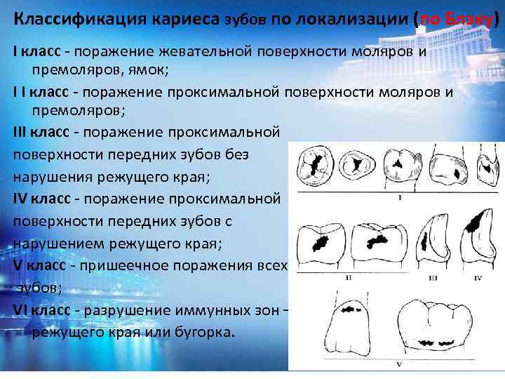 Классификация кариеса зубов по локализации (по Блэку) I класс - поражение жевательной поверхности моляров