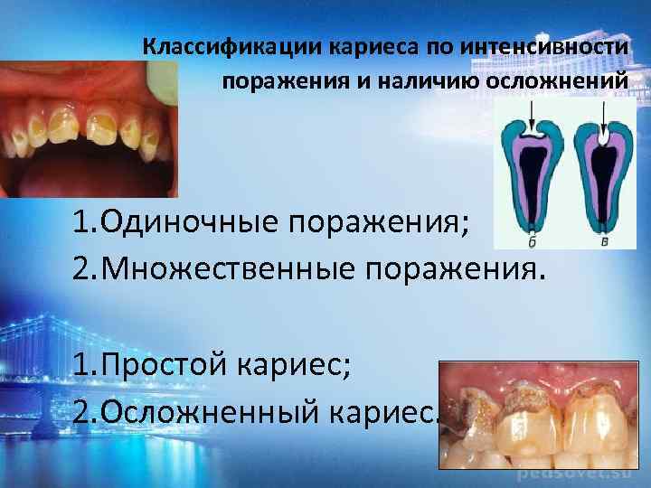 Классификации кариеса по интенсивности поражения и наличию осложнений 1. Одиночные поражения; 2. Множественные поражения.