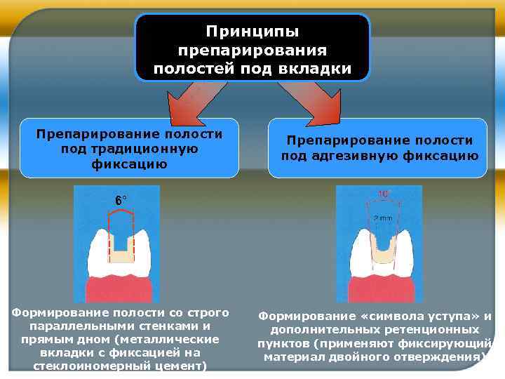 Принципы препарирования полостей под вкладки Препарирование полости под традиционную фиксацию Препарирование полости под адгезивную