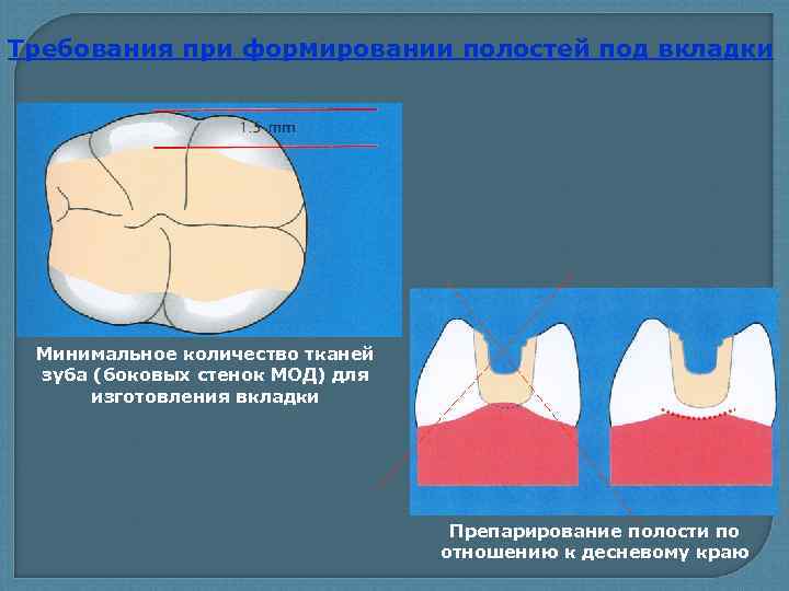 Требования при формировании полостей под вкладки Минимальное количество тканей зуба (боковых стенок МОД) для