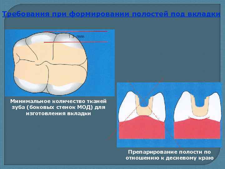 Дефекты лечения. Препарирование твердых тканей зуба. Препарирование зуба под вкладку. Препарирование полости под вкладку. Принципы препарирования под вкладку.