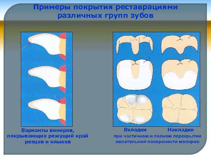 Примеры покрытия реставрациями различных групп зубов Варианты виниров, покрывающих режущий край резцов и клыков
