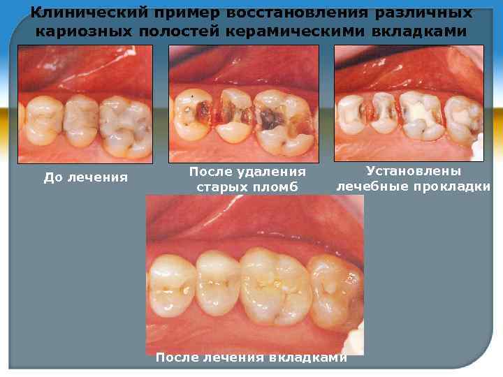 Клинический пример восстановления различных кариозных полостей керамическими вкладками До лечения После удаления старых пломб