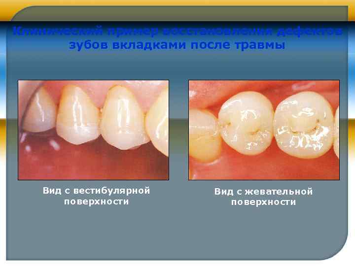 Клинический пример восстановления дефектов зубов вкладками после травмы Вид с вестибулярной поверхности Вид с