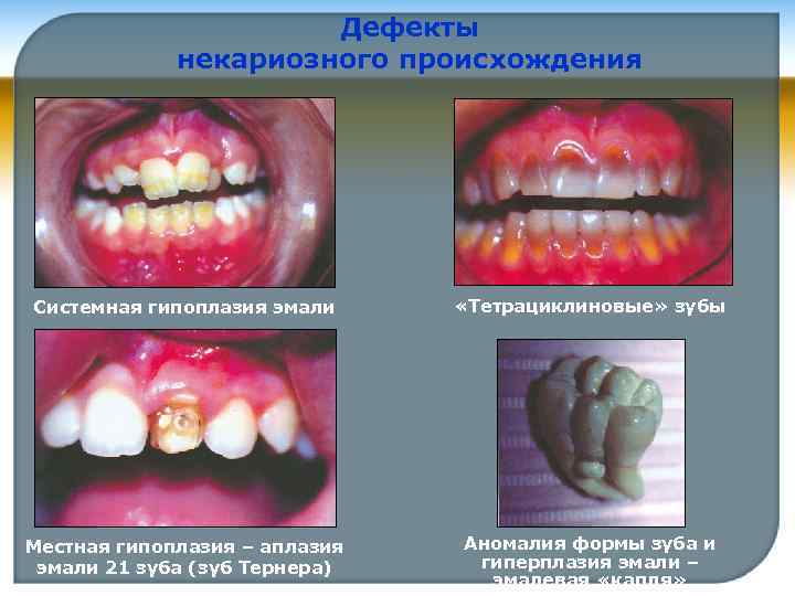Дефекты некариозного происхождения Системная гипоплазия эмали «Тетрациклиновые» зубы Местная гипоплазия – аплазия эмали 21