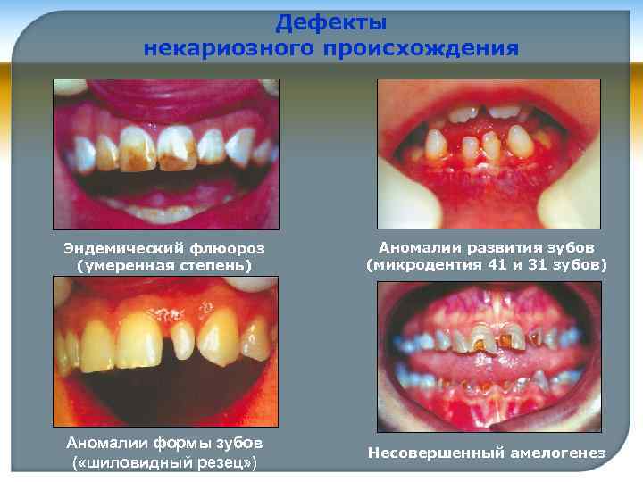 Дефекты некариозного происхождения Эндемический флюороз (умеренная степень) Аномалии развития зубов (микродентия 41 и 31