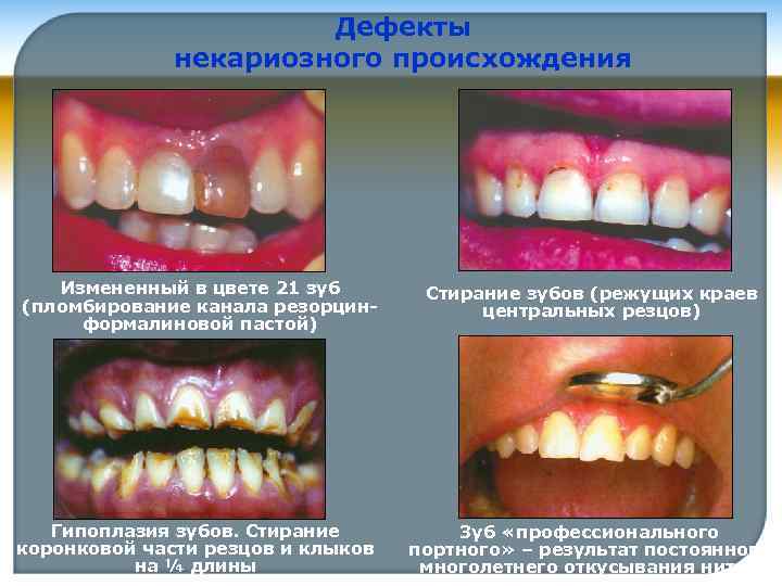 Дефекты некариозного происхождения Измененный в цвете 21 зуб (пломбирование канала резорцинформалиновой пастой) Стирание зубов