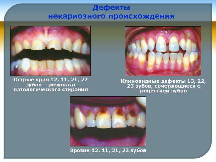 Дефекты некариозного происхождения Острые края 12, 11, 22 зубов – результат патологического стирания Клиновидные