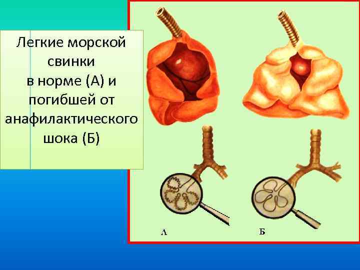 Легкие морской свинки в норме (А) и погибшей от анафилактического шока (Б) 