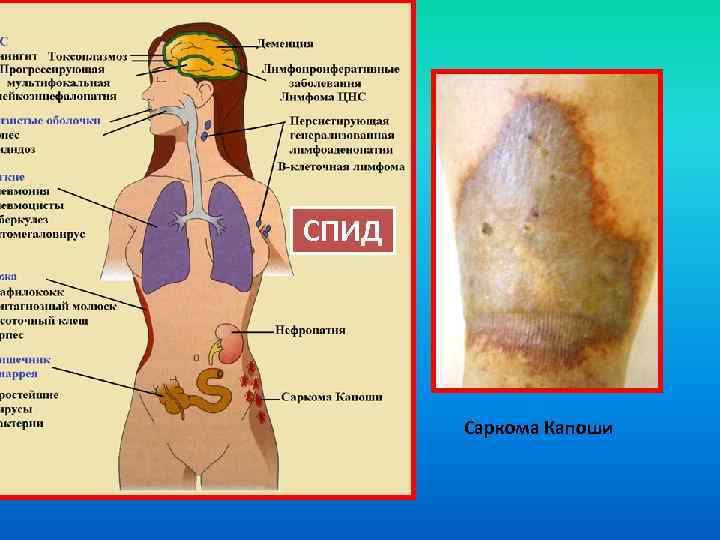 СПИД Саркома Капоши 