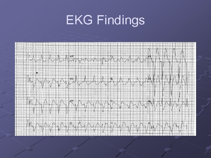 EKG Findings 