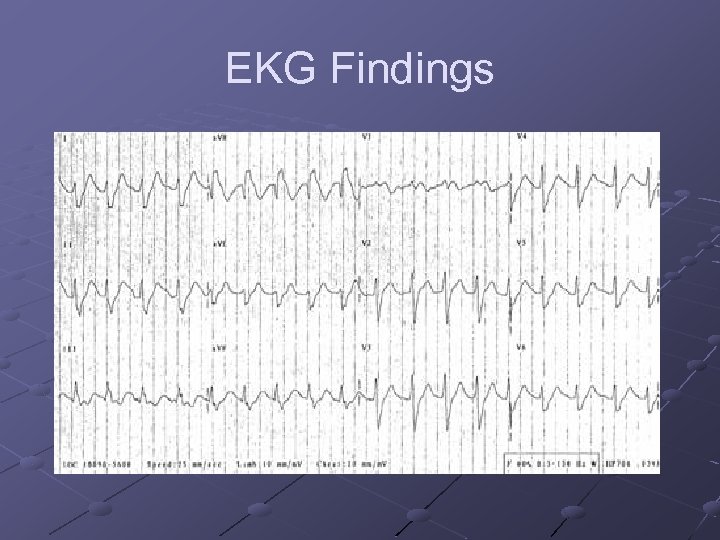 EKG Findings 