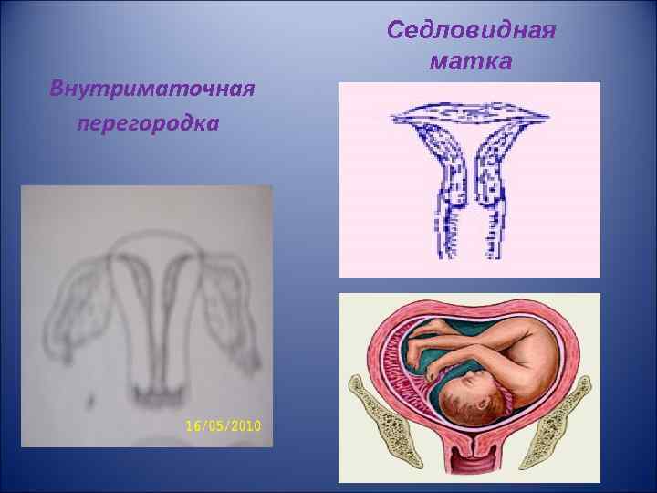 Внутриматочная перегородка Седловидная матка 