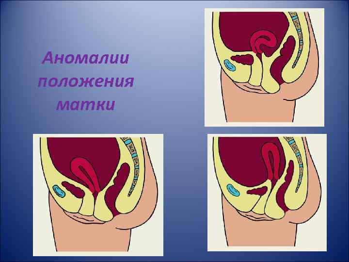 Аномалии положения матки 